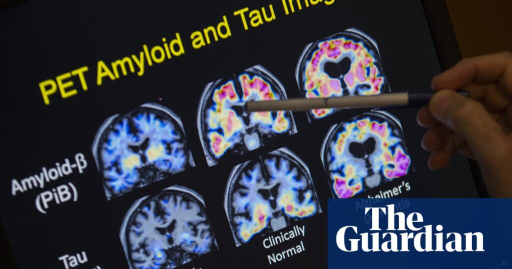 Australia approves new drug to treat early Alzheimer’s disease | Alzheimer's