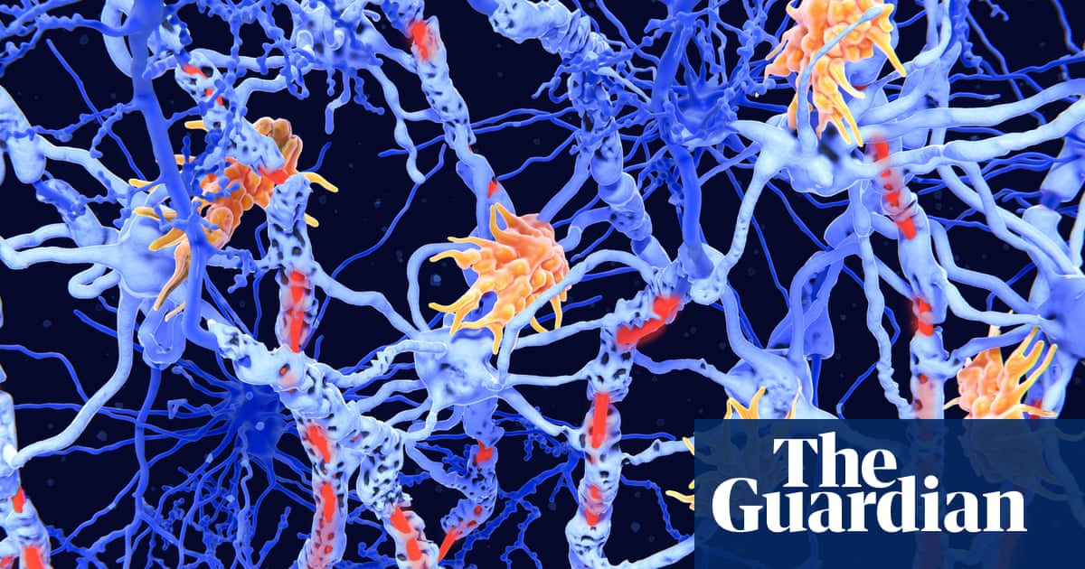 ‘Inverse vaccines’: the promise of a ‘holy grail’ treatment for autoimmune diseases | Well actually