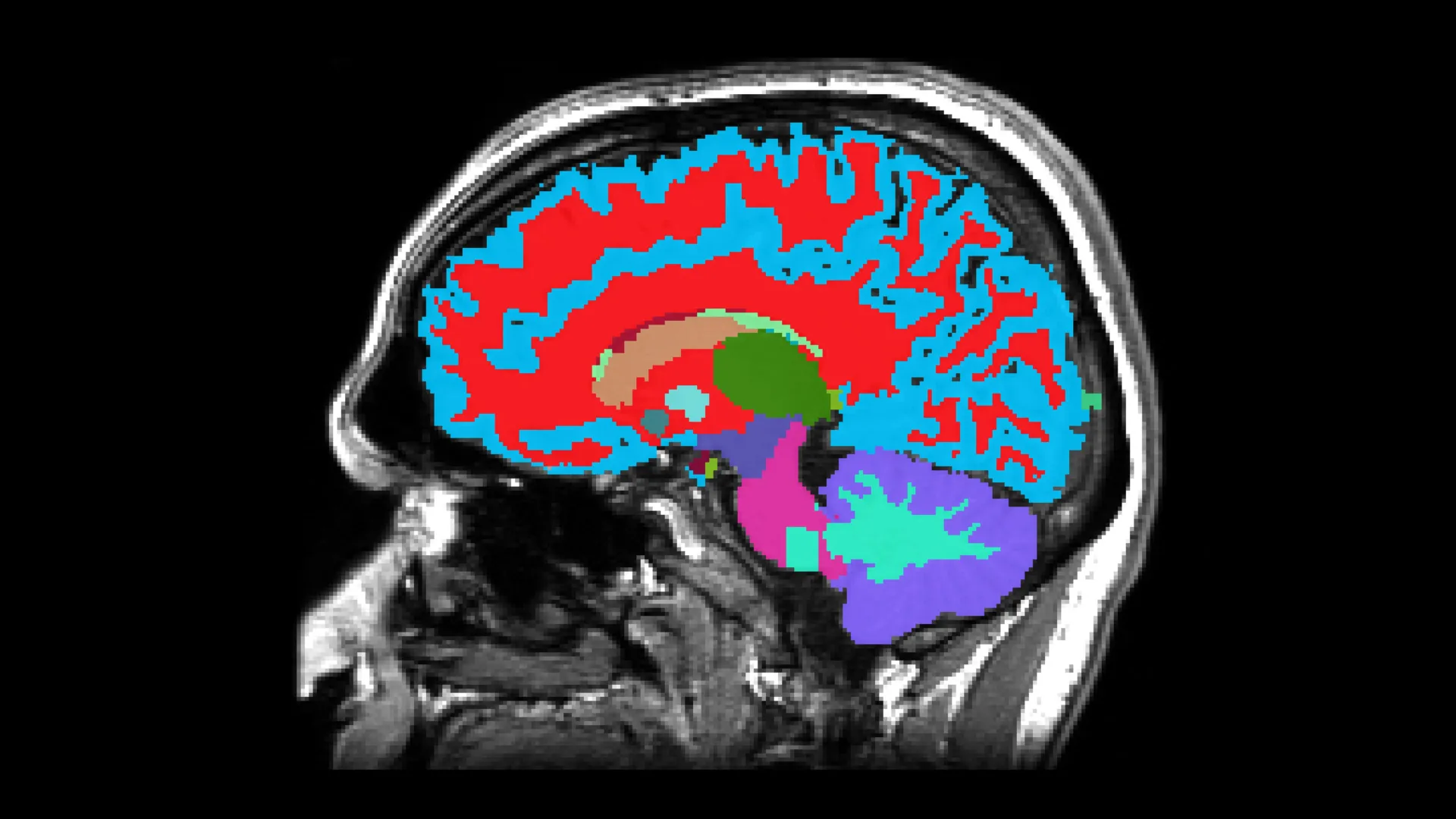 A midlife MRI that spots rapid aging and signals disease long before symptoms