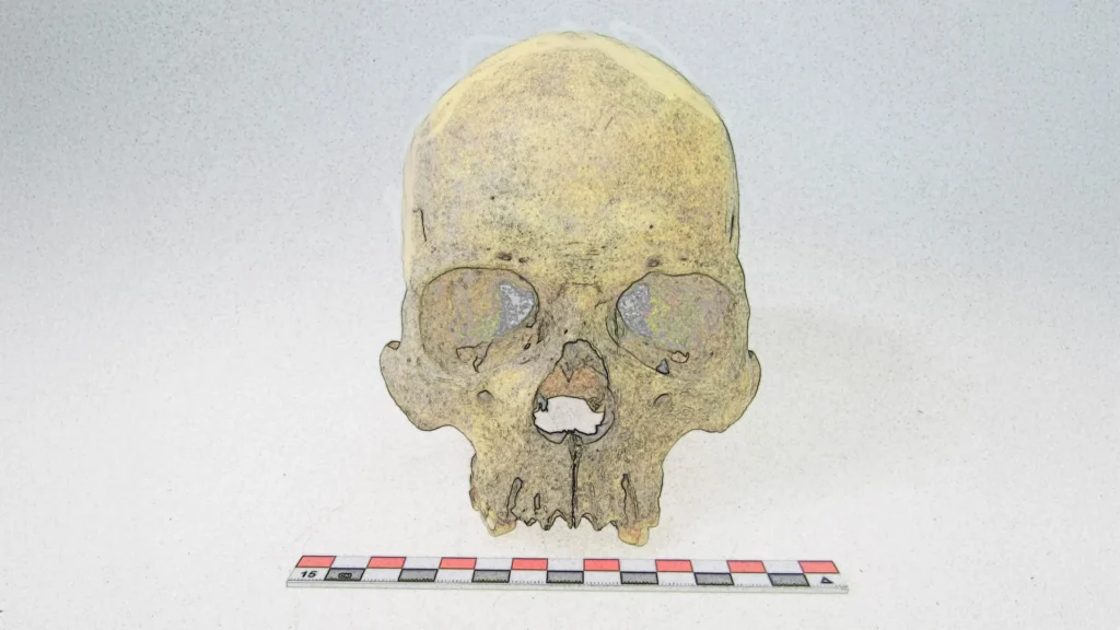 Ancient DNA reveals leprosy hit the Americas long before colonization