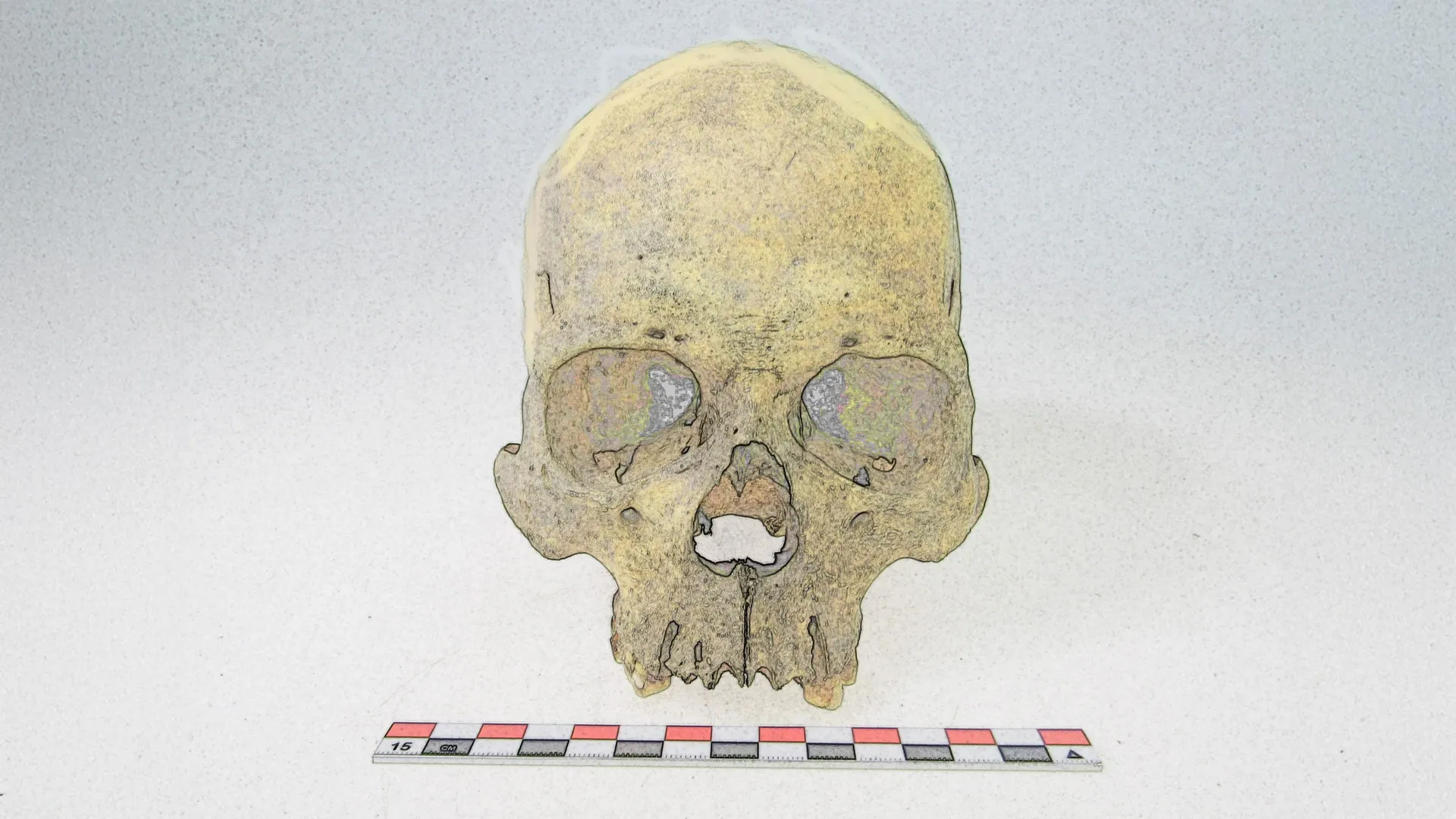Ancient DNA reveals leprosy hit the Americas long before colonization