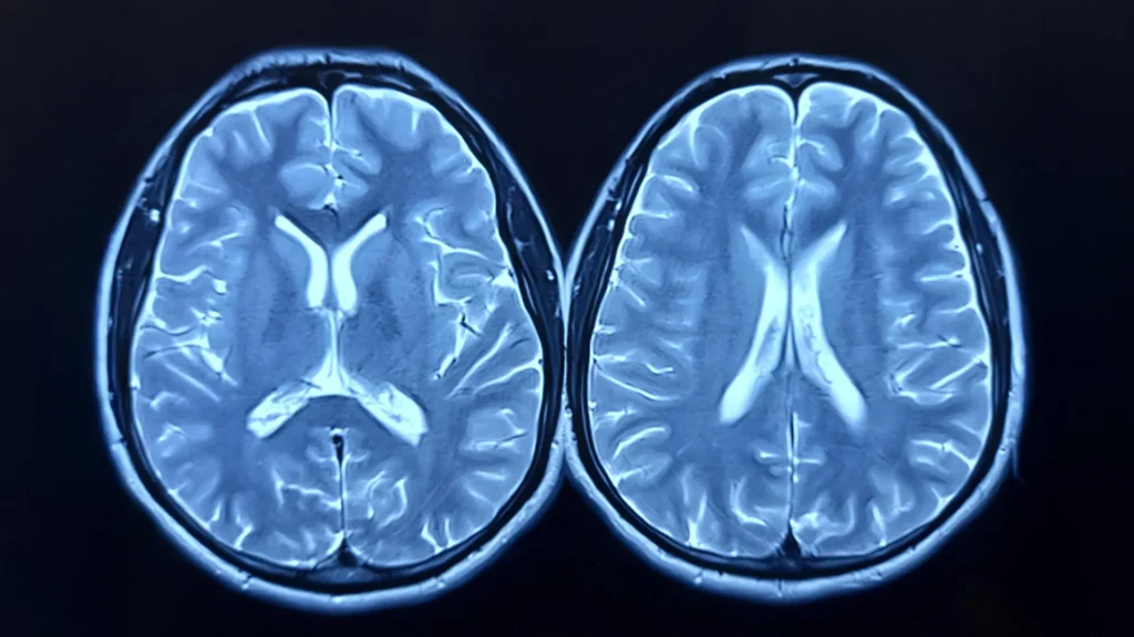 Even without catching COVID, the pandemic may have quietly aged your brain