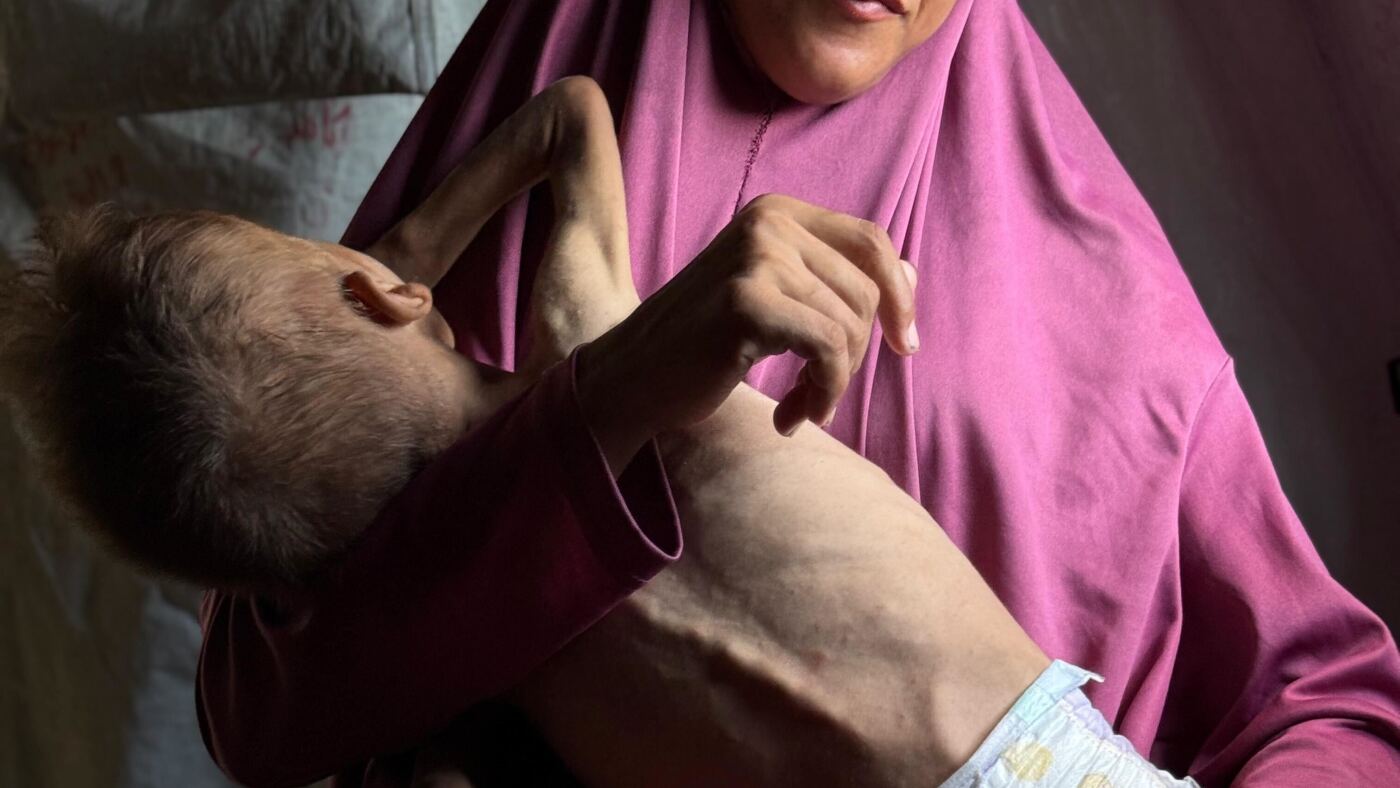 Gaza children's health damaged permanently by malnutrition, doctors warn : NPR