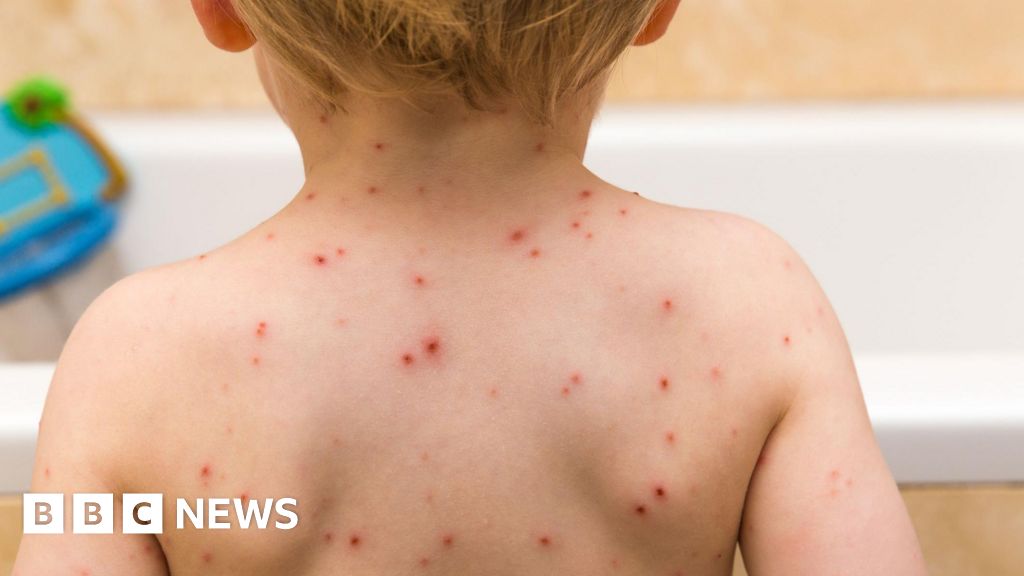 Children offered chickenpox vaccine on NHS