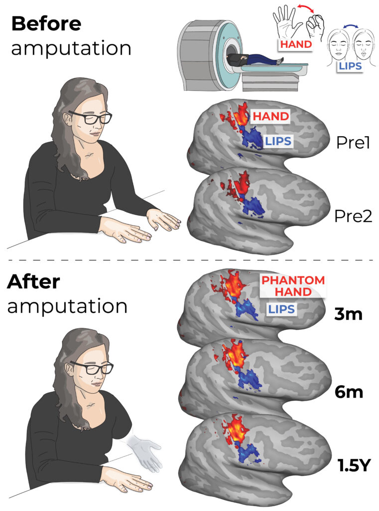 Phantom limb study rewires our understanding of the brain