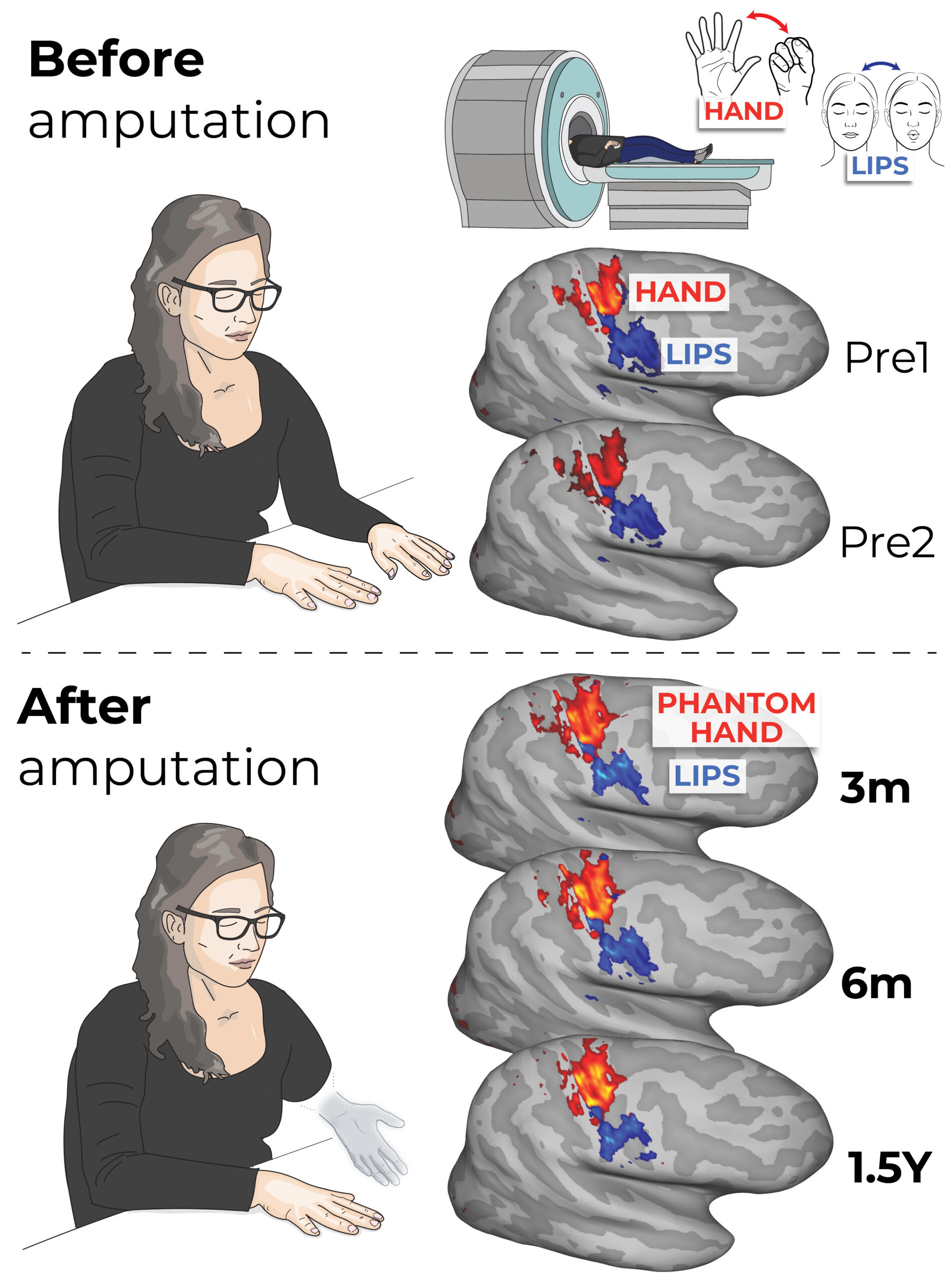Phantom limb study rewires our understanding of the brain