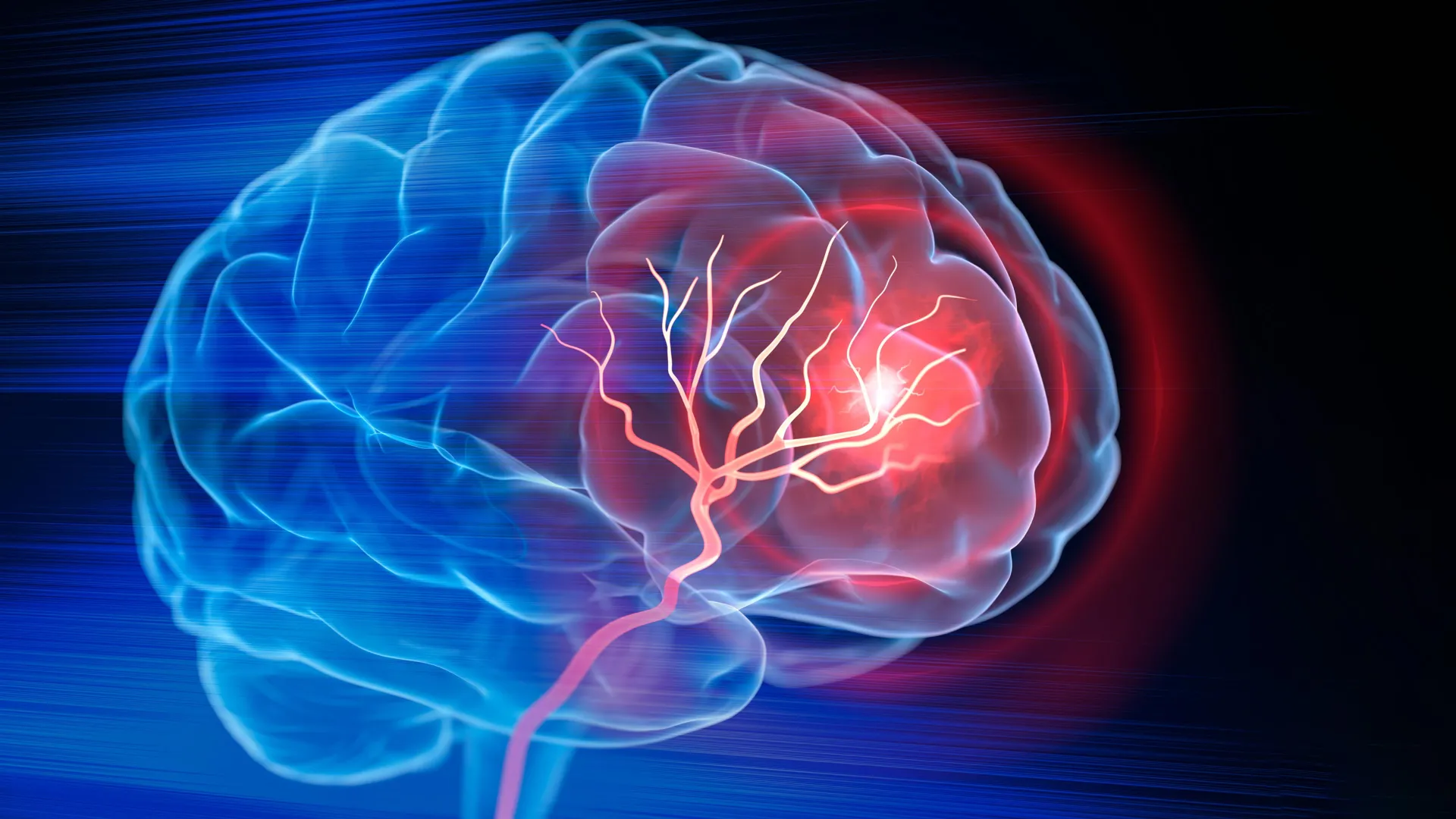 Weight loss drug Ozempic could protect the brain from stroke