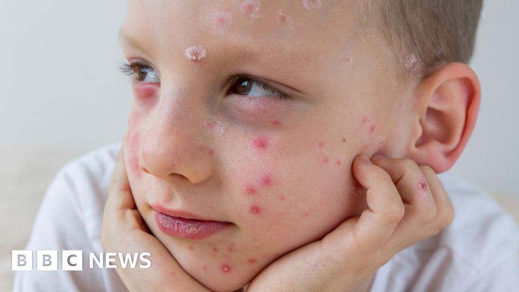 What is chickenpox and who can get the vaccine?