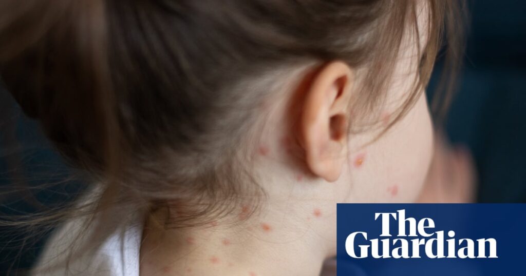 Why is chickenpox vaccination being offered to children in England next year? | Chickenpox